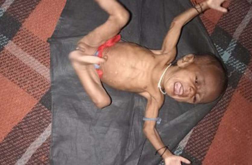 irresponsibility: malnutrition death in shahdol madhya pradesh हड्डियों से चिपक गया था मांस, धंस गईं थी आंखें, कुपोषण से सांसें भी साथ छोड़ गईं...