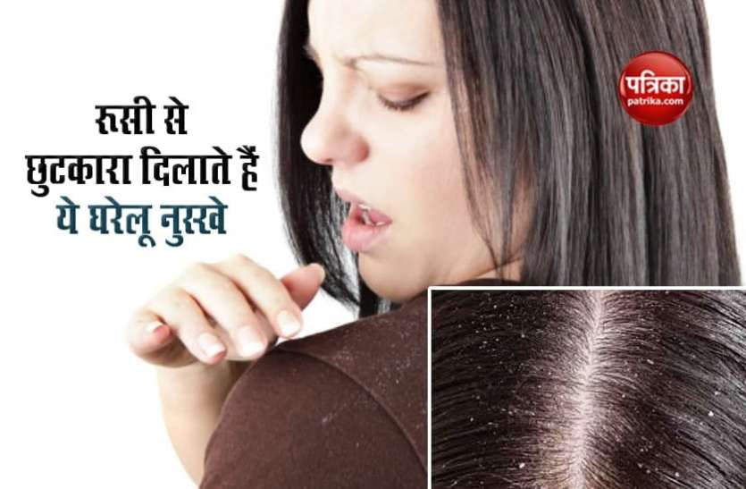 dandruff problem in winter सर्दियों में डैंड्रफ की समस्या से कैसे पाएं छुटकारा, जान लें इन घरेलू नुस्खों का आसान तरीका