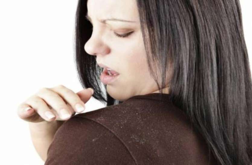 Natural way to avoid dandruff.jpg सर्दी में डैंड्रफ की समस्या से है परेशान? इन 4 नैचुरल तरीकों से करें इसका समाधान