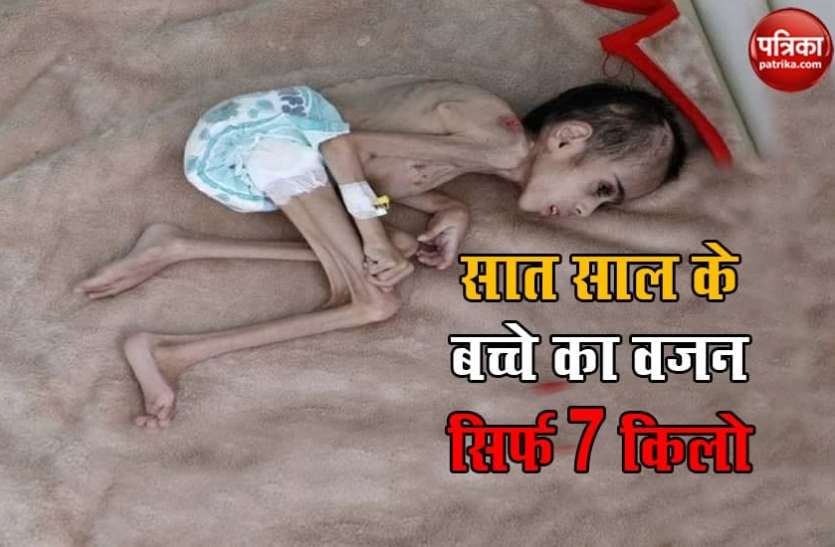 Cerebral Palsy सात साल के बच्चे का सिर्फ 7 किलो का वजन, इसकी बीमारी जानकर आप हो जाएंगे दंग