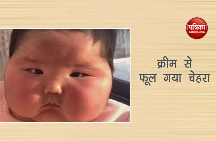 cream गलती से मां ने लगा दी ऐसी क्रीम बच्चे का चेहरा फूल कर हो गया ऐसा