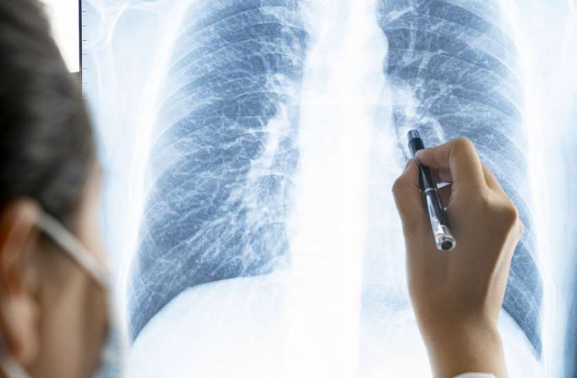 lungs.jpg स्मोकर से भी ज्यादा खराब हो सकती है कोरोना मरीज के फेफड़ों की हालत, एक्स-रे में दिखी खौफनाक सच्चाई
