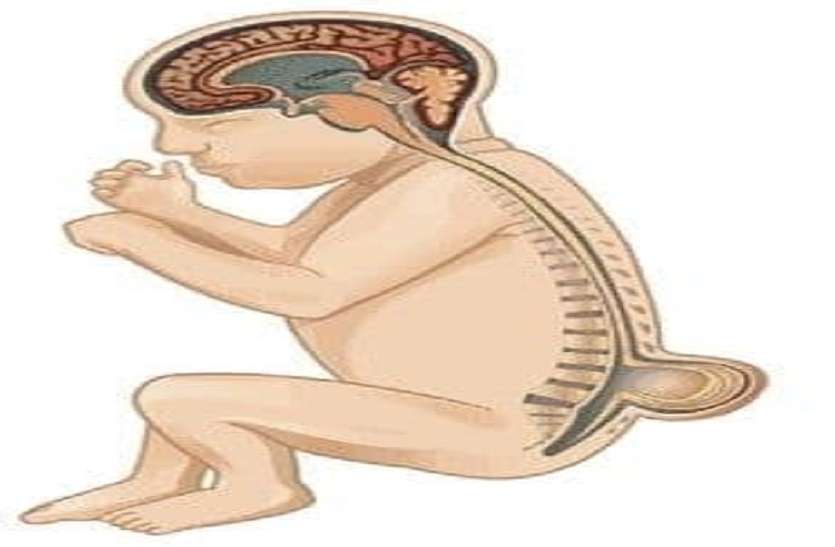 Spina bifida can cause the usual disability हमेशा की विकलांगता का कारण बन सकता है spina bifida