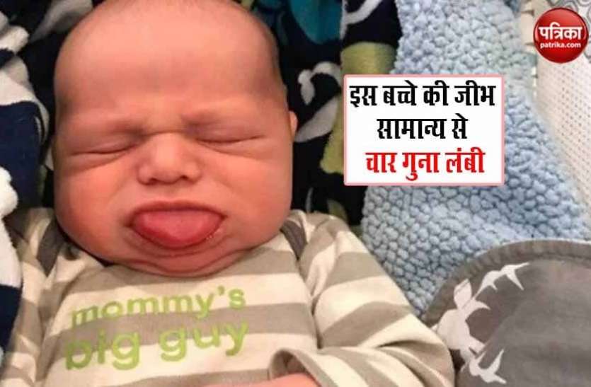 A child with a rare disease बड़ी ही दुर्लभ बीमारी से जूझ रहा बच्चा, काटने के बाद भी बढ़ती ही जा रही है जीभ