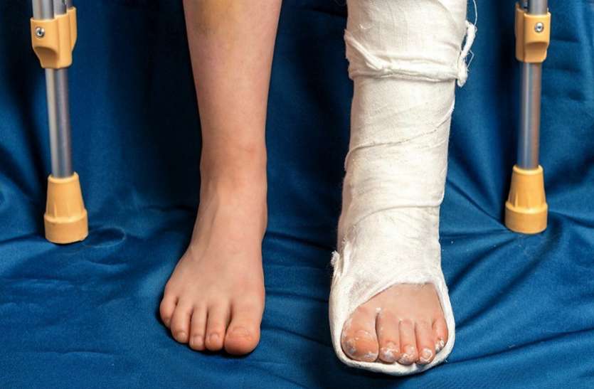 fracture इस वजह से टूट सकती हैं हड्डियां, रखें सावधानी