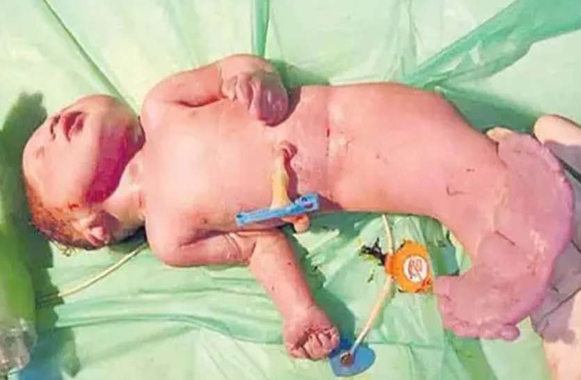 mermaid baby हैदराबाद में जन्मा जलपरी जैसा बच्चा, आधा इंसान और आधा मछली का शरीर