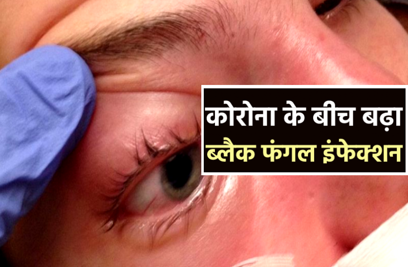 News कोरोना के बीच एक और बड़ी मुसीबत : सिर्फ राजधानी में ही 10 दिनों में 50 लोगों में ब्लैक फंगल इंफेक्शन की पुष्टि