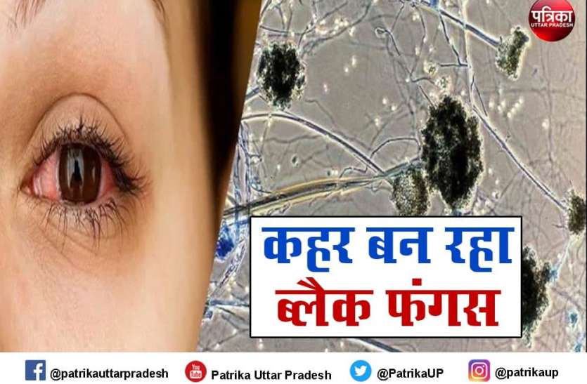 chhindwara Black fungus: स्पेशल टीम करेगी निगरानी, इलाज के लिए बनेगा अलग वार्ड