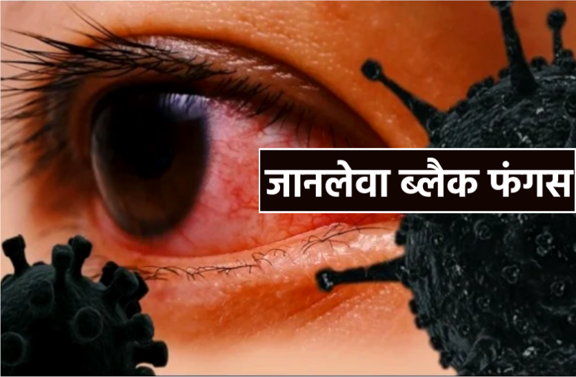 News तेजी से बढ़ रहा ब्लैक फंगस का खतरा : 10 दिनों में दो मरीजों की मौत, अब इस इंजेक्शन की भी कालाबाजारी शुरु