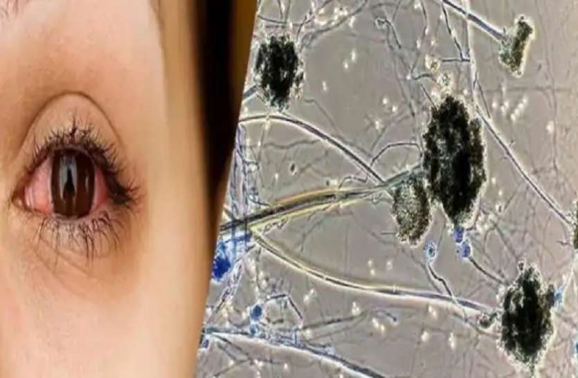 Black fungus Covid-19 : कोविड-19, ब्लैक फंगस के पैकेज का चयन अब सॉफ्टवेयर से