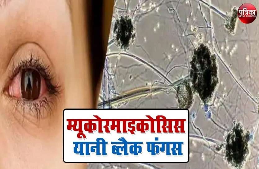 ब्लेक फंगस के लिए बनाया केयर सेंटर
