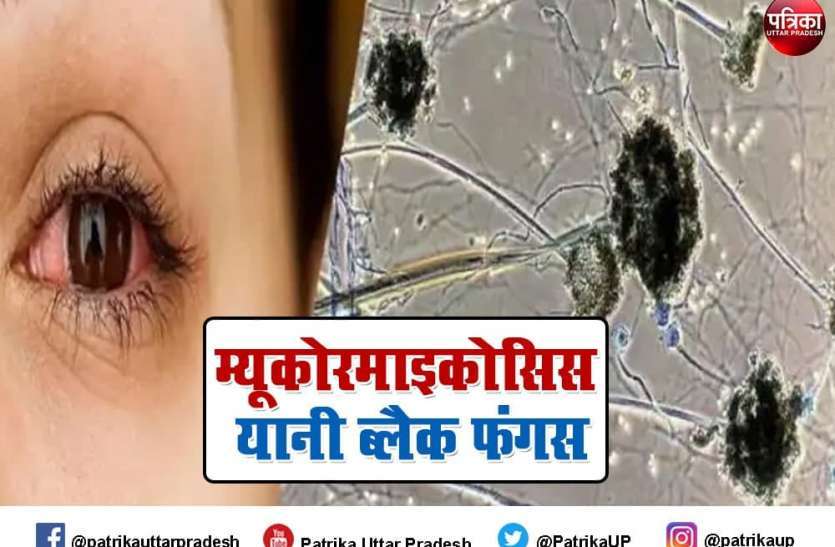 बालोद पहुंचा ब्लैक फंगस: कोरोना से ठीक होकर घर लौटा युवक दो दिन में ही फंगस की चपेट में आया, हालत गंभीर बालोद पहुंचा ब्लैक फंगस: कोरोना से ठीक होकर घर लौटा युवक दो दिन में ही फंगस की चपेट में आया, हालत गंभीर