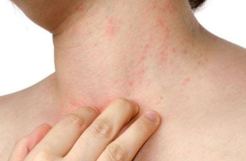 Heat Rash Home remedies for Heat Rash :- घमौरियों की चुभन से परेशान हो गए हैं तो यह करें घरेलू उपाय