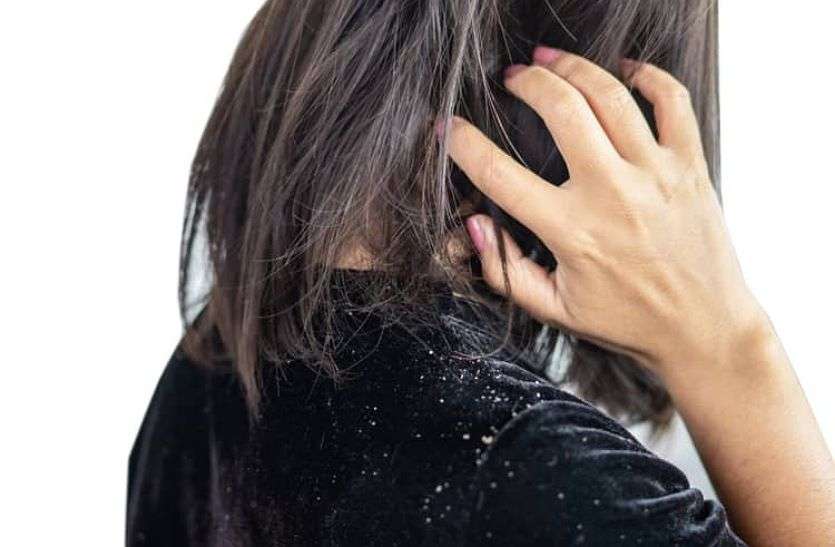 Dandruff home remedy Dandruff home remedy :- डैंड्रफ से हैं परेशान तो घर पर करें ये उपाय