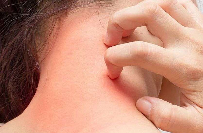 Eczema Home Remedies :- एक्जिमा से हो गए हैं परेशान तो अब करें यह घरेलू उपाय Eczema Home Remedies :- एक्जिमा से हो गए हैं परेशान तो अब करें यह घरेलू उपाय