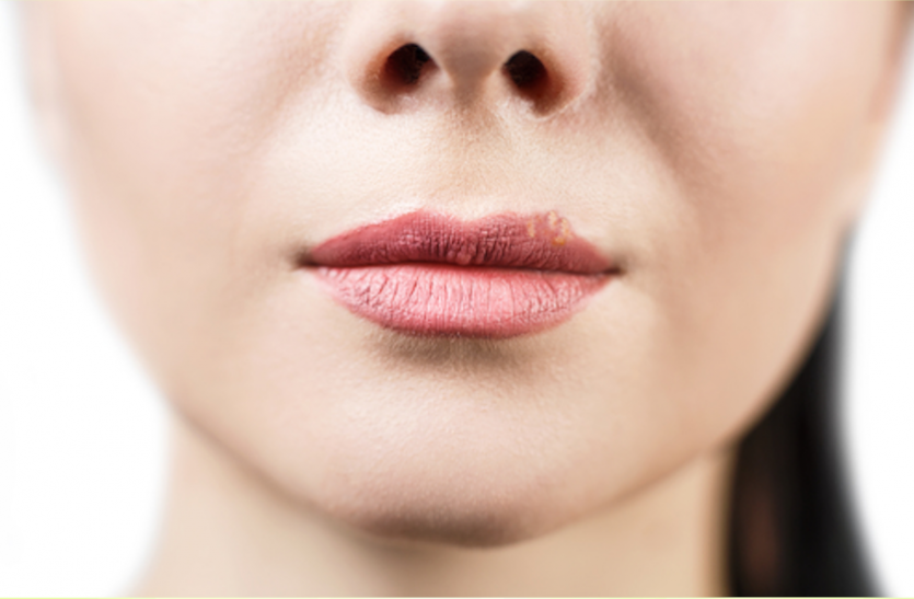 Chapped Lips Home Remedies