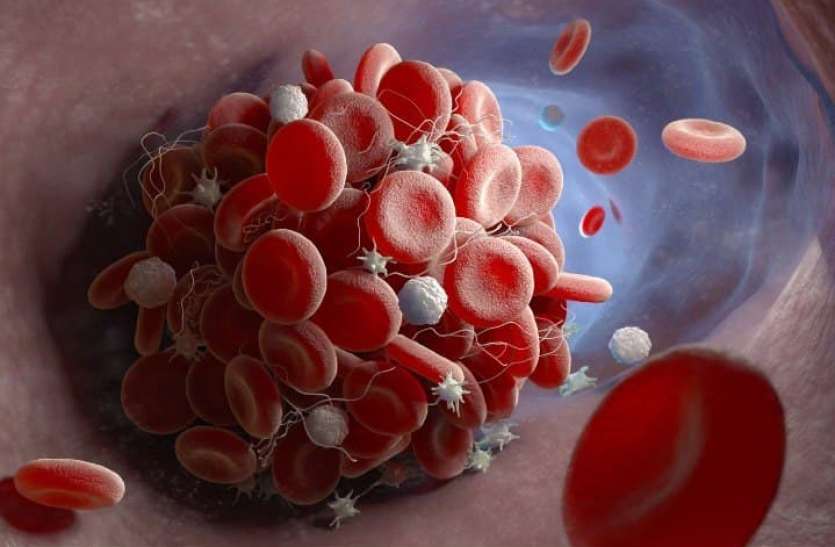 blood_clot.jpg कोरोना से ठीक हुए मरीजों को अब एक और नई समस्या, काटने पड़ सकते हैं शरीर के अंग
