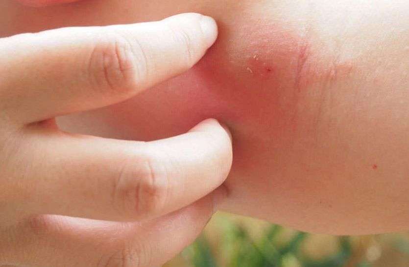 Skin Problem Skin Problem : इन कारणों से होता है चर्म रोग, इस तरह करें बचाव