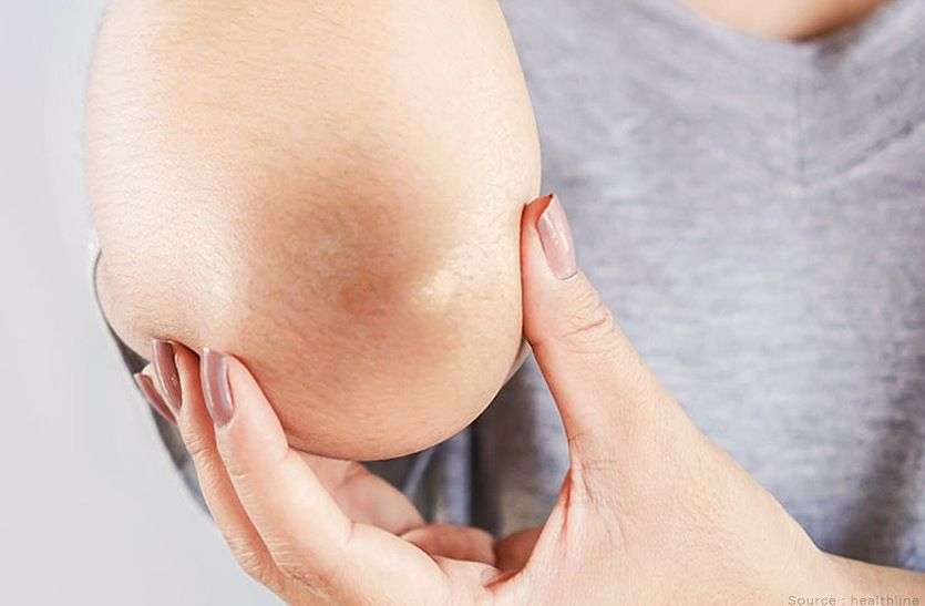 Blackness of knees and elbows Dark Elbow Home Remedies: कोहनी के रंग को हल्का करने के घरेलू उपाय