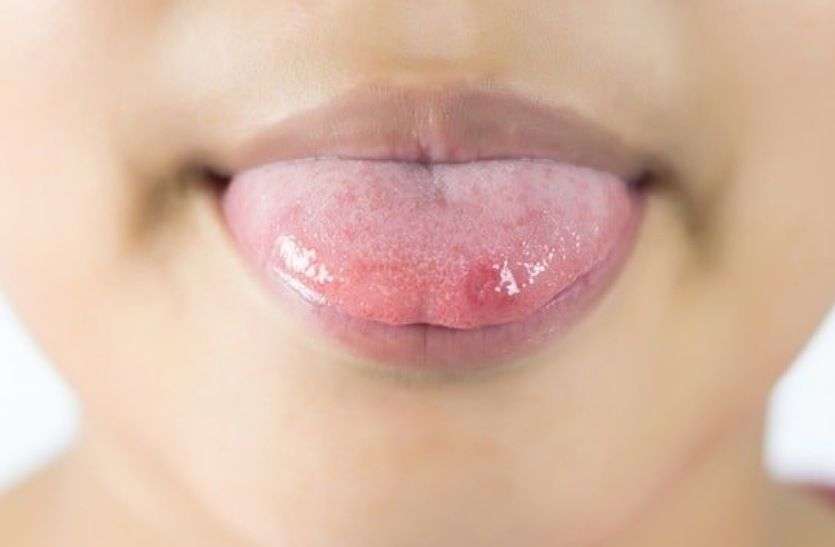 do-this-remedy-to-remove-the-ulcers-on-the-tongue