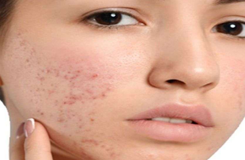 Acne marks Acne marks : कील मुंहासे के निशानों को दूर करना है तो अपनाएं यह घरेलू टिप्स