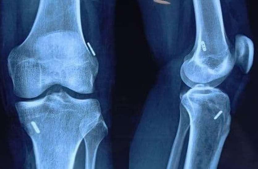 All Inside Arthroscopy ACL Surgery for players 'ऑल इनसाइड आर्थ्रोस्कोपी एसीएल सर्जरी' खिलाड़ियों के लिए वरदान
