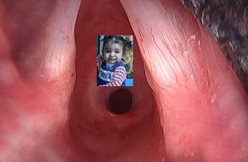 दुर्लभ बीमारी subglottic stenosis से पीड़ित रुद्रांश स्ट्रीट वेंडर का दो साल का बेटा subglottic stenosis बीमारी से पीड़ित, कृत्रिम सांस के सहारे जीवित