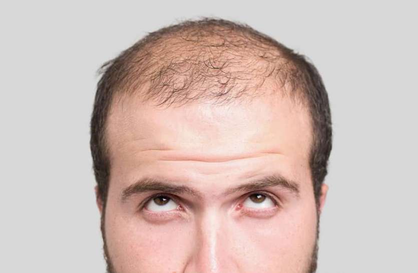 baldness.jpg Natural Way to Reduce Hair Fall: बाल झड़ने से रोकने के लिए आजमाएं ये 5 प्राकृतिक उपाय, गंजेपन से मिलेगा छुटकारा