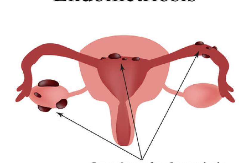 endo.jpg Endometriosis: एंडोमेट्रियोसिस क्या होता है? जानिए इसके कारण और लक्षण