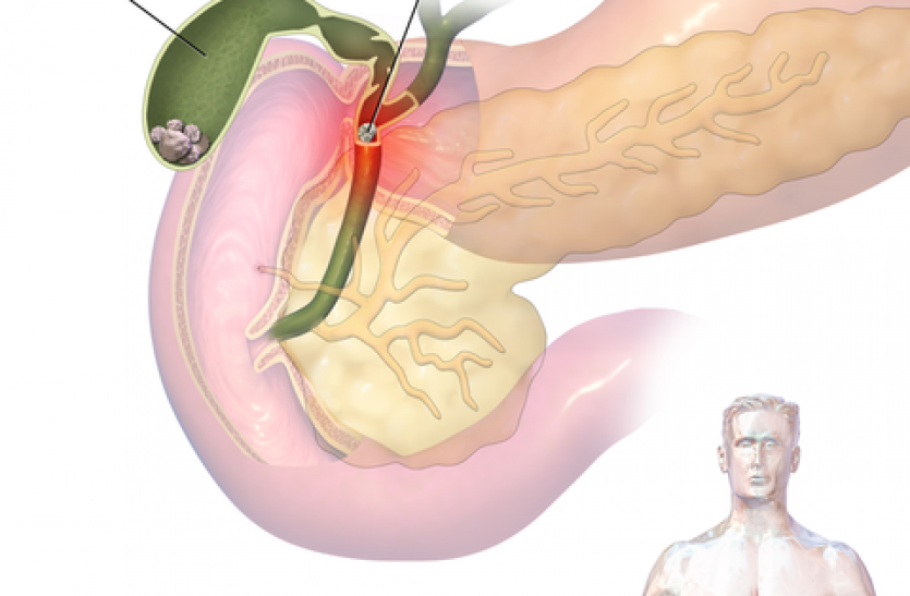 gallstones.png Home Remedies of Gall Stone: पित्त की पथरी के घरेलू उपाय