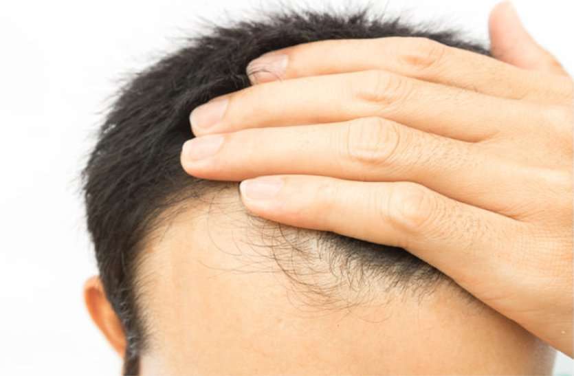 Hair Care Tips : अगर आप गंजेपन का शिकार हो रहे है तो इन तरीको को अपनाकर इससे बच सकते है
