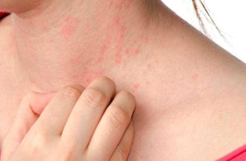 health news Health News: डेंगू और चिकनगुनिया में ही नहीं, इन बीमारी में भी घटती हैं प्लेटलेट्स