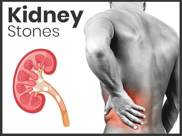 kidney_stone.jpg