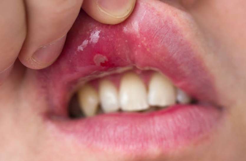 ulcers.jpg Mouth Ulcers: अगर आप भी मुंह के छालों से छुटकारा पाना चाहते है तो आजमाएं घरेलू उपचार