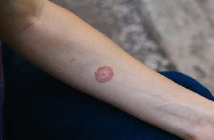 ringworm.jpg Home Remedies for Ringworm: अगर आप भी दाद से परेशान है तो ये चीज आपको दाद से छुटकारा दिला सकते है