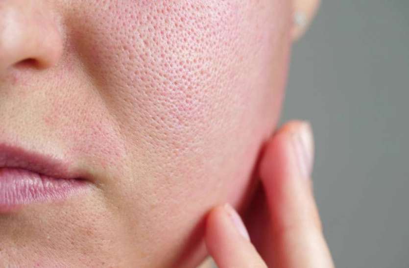 open_pores.jpg Skin Care Tips: चेहरे के ओपन पोर्स से आपको छुटकारा दिलाएगा ये 5 घरेलू उपाय
