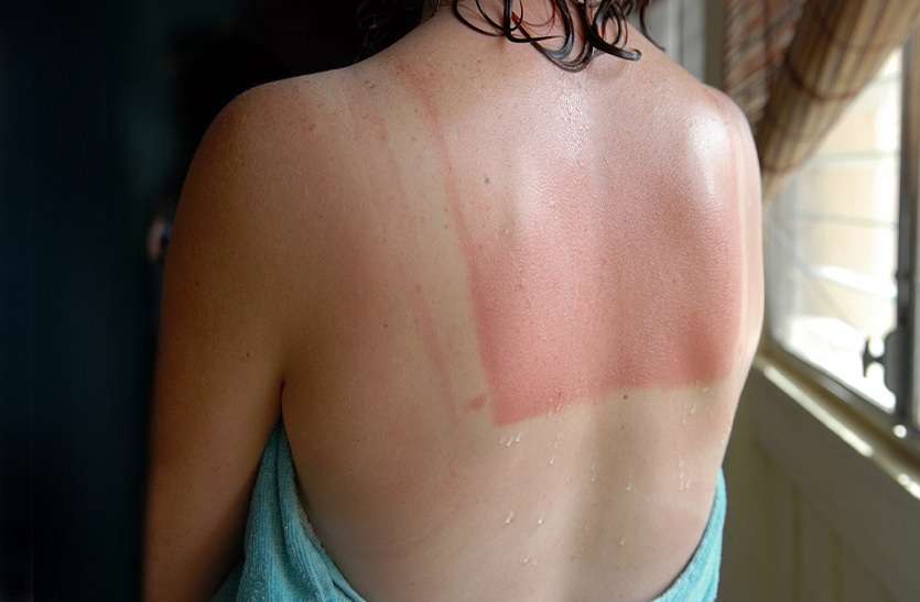 sun_burn.jpg