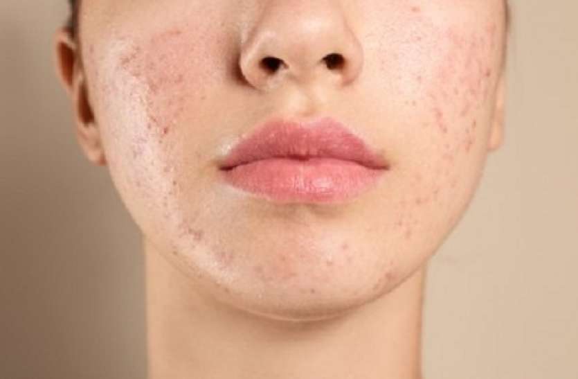 abscess.jpg Home Remedies for Abscess: अगर आप फोड़े-फुंसियों से परेशान हैं तो तुरंत अपनाएं घरेलू उपाय