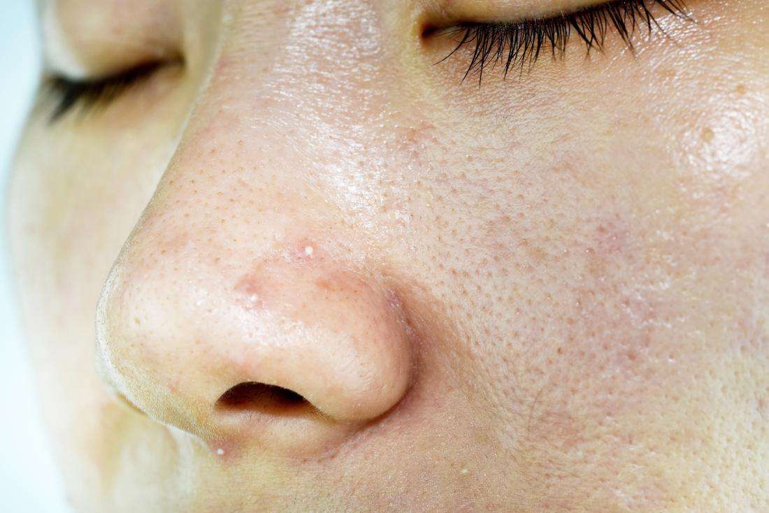 close-up-of-a-womans-oily-skin.jpg