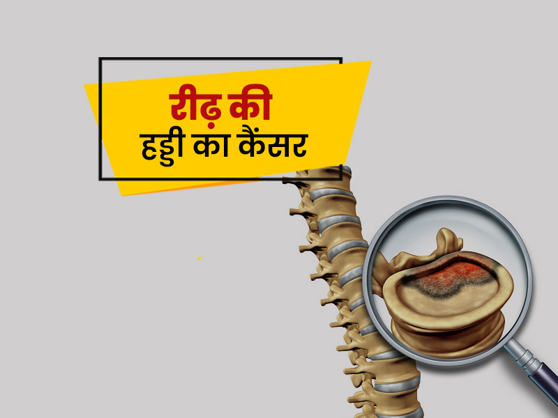 know Causes of Spinal Cord Cancer symptoms and Treatment