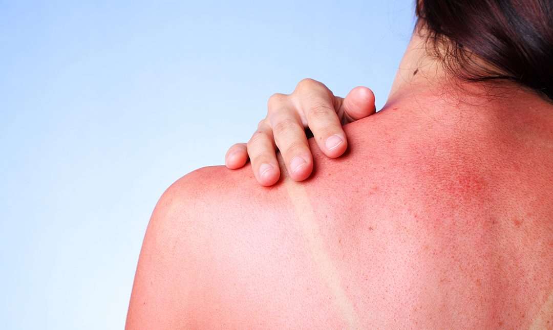 sunburn.jpg