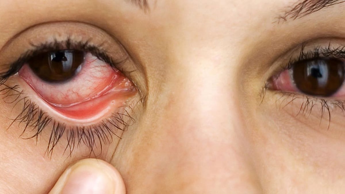 amazing home remedies to cure eye pain | आंखों में दर्द की समस्या से रहते  हैं परेशान, तो ये घरेलू उपाय आपके आ सकते हैं काम | Patrika News