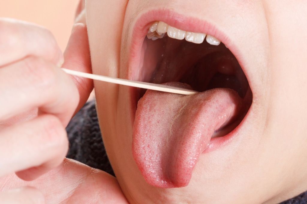 Best-Home-Remedies-For-Tonsillitis