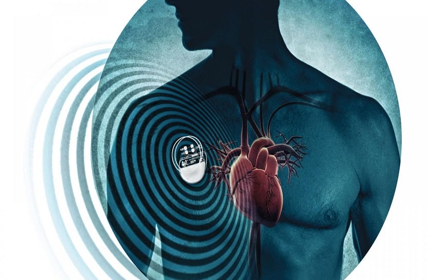 Calcium blockage in the heart, life saved by rota-tripsy technique