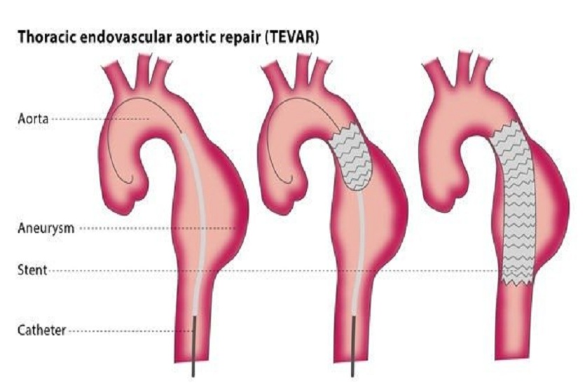TEVAR प्रोसिजर से बचाई मरीज की जान