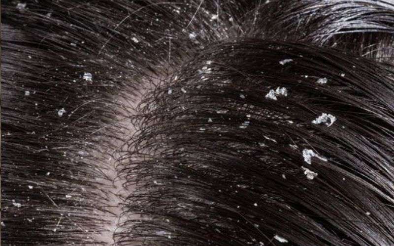 Little bumps on the forehead, Nail-acne, Skin problems, Skin rash, Rash on the face, Skin diseases, Dandruff,