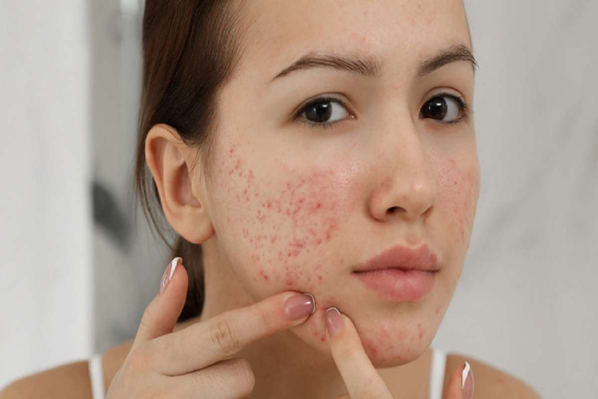 pimple.jpg