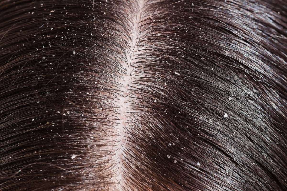 dandruff.jpg