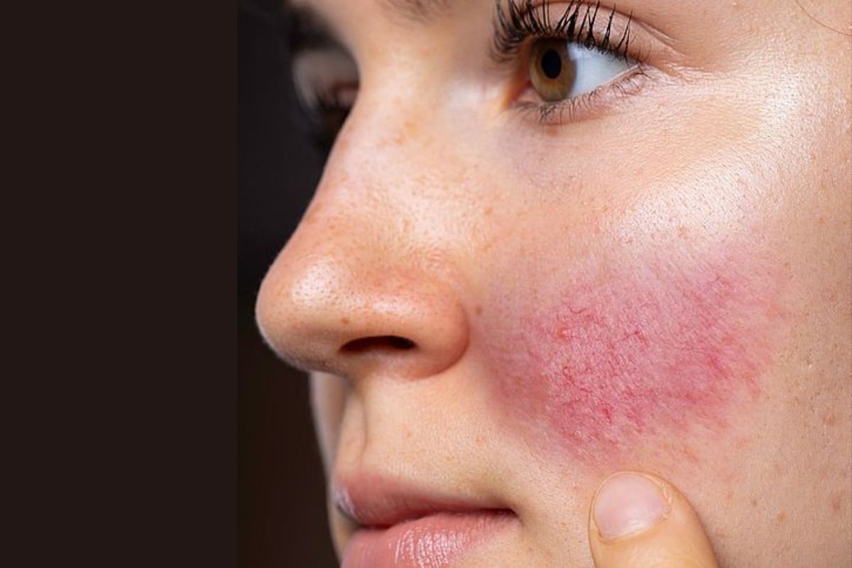 rash_on_face_swelling_and_redness_can_caused_by_increased_pitta.jpg