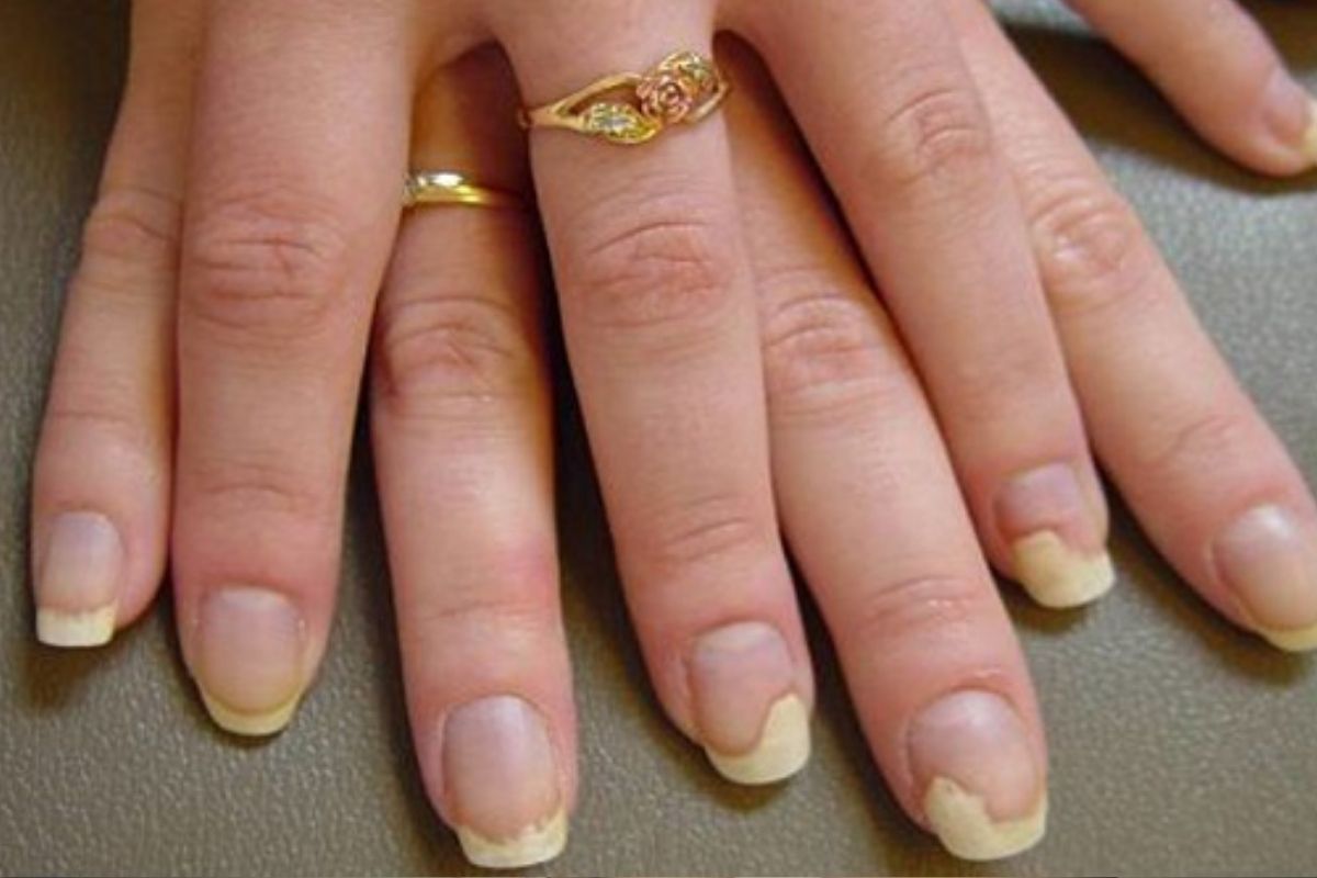 Artificial nails and diabetes increase fungal infection | नाखूनों के टूटने,  पकने और बदलते रंग की वजह है फंगल इंफेक्शन, इन गलत आदतों और बीमारियों से  होती है समस्या ...